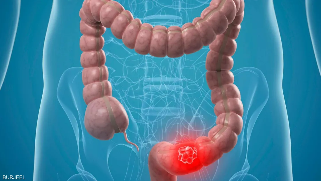 5 نصائح للفوز بأمعاء صحية بفصل الصيف